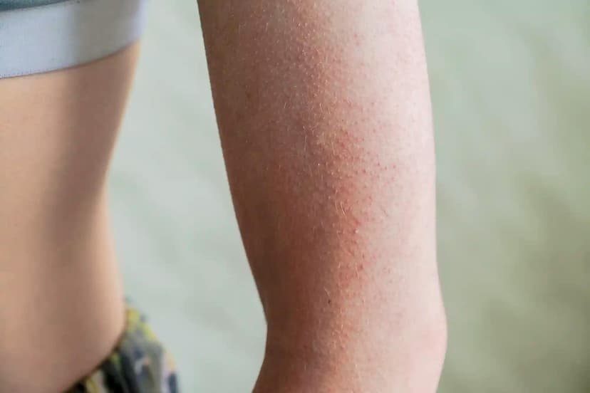how to get rid of red bumps on arms